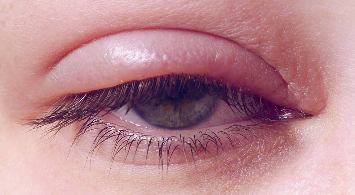 Tratamiento Blefaritis Yag Ocular