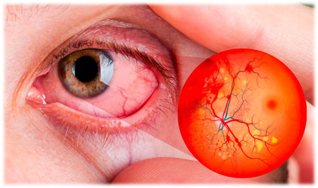 Retinopatía Diabética Yag Ocular