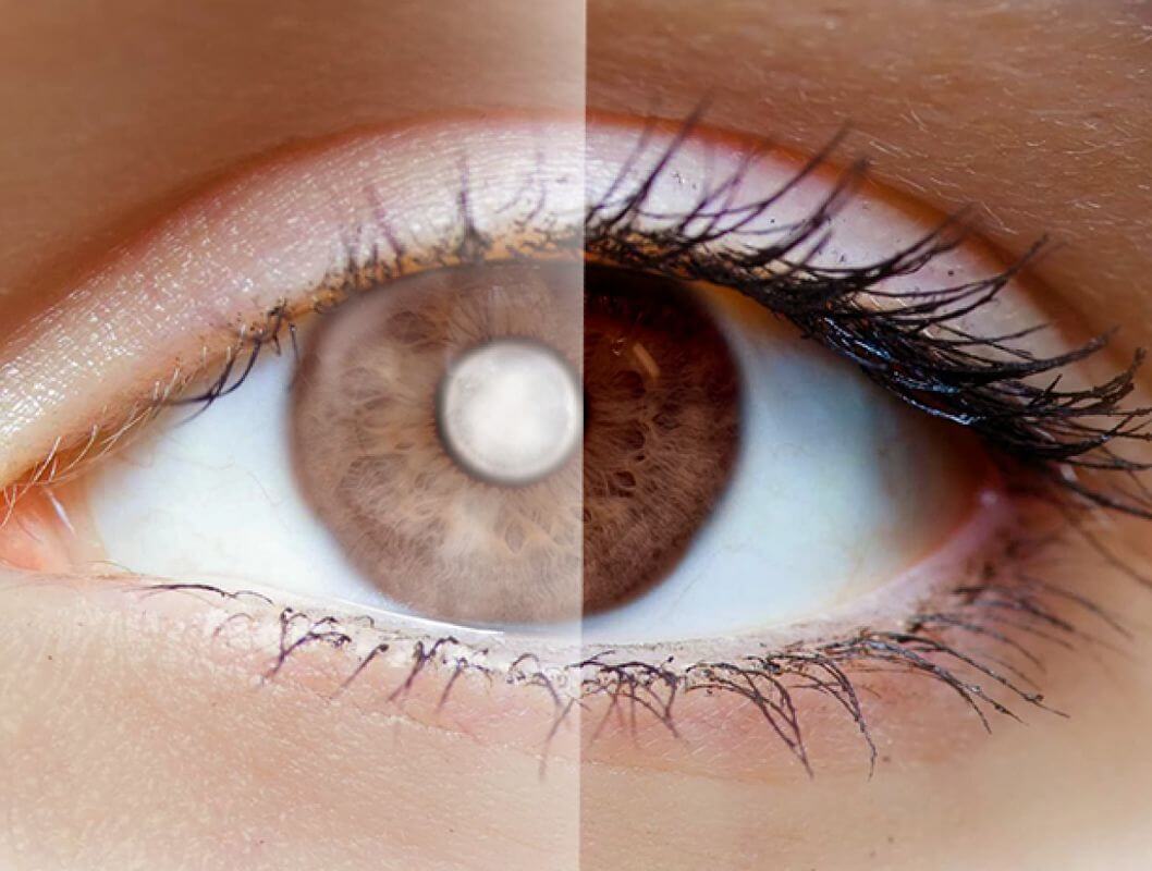 Tratamiento Cataratas Yag Ocular