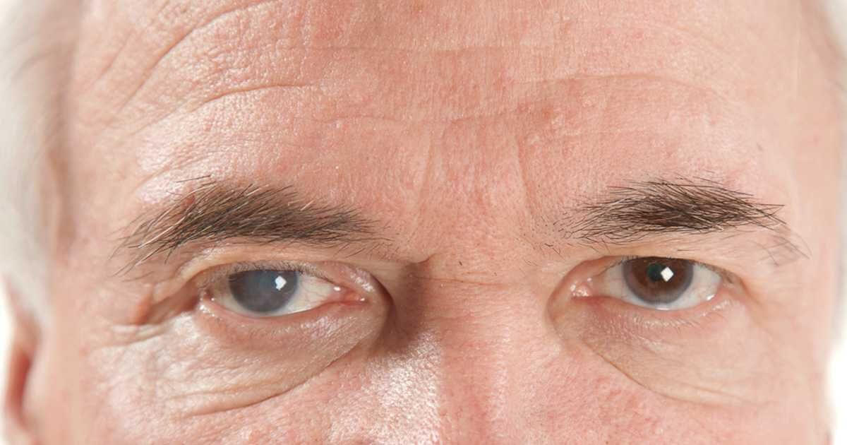 Detección y tratamiento de glaucoma Yag Ocular