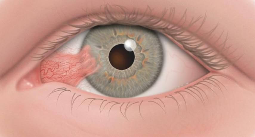Tratamiento para Pterigion o carnosidad en el ojo